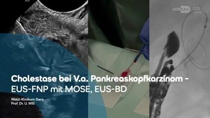 Cholestase bei V.a. Pankreaskopfkarzinom. EUS-FNP mit MOSE, EUS-BD.