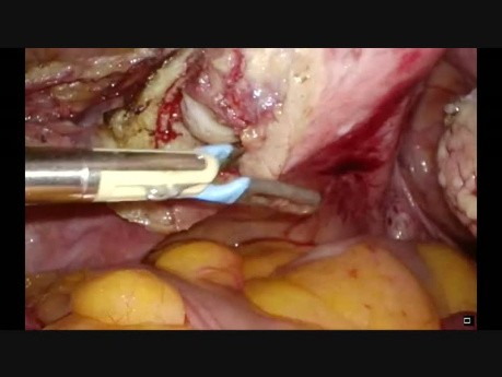 Totale laparoskopische Hysterektomie 