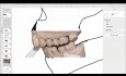 Das „letzter-Zahn-im-Bogen“-Syndrom