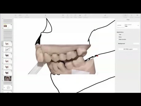 Das „letzter-Zahn-im-Bogen“-Syndrom