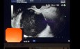 Endoskopische Drainage einer thorakoabdominellen Pseudozyste