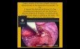 Endometriose-Broschüre