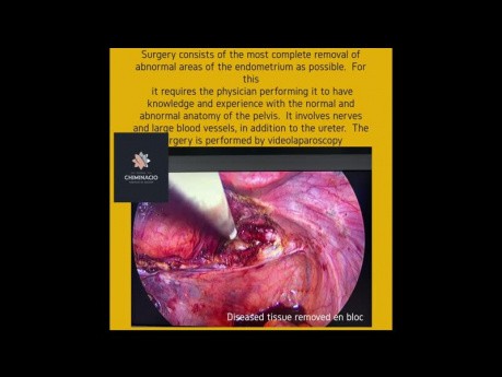 Endometriose-Broschüre