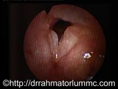 Reinke-Ödem und Polyp