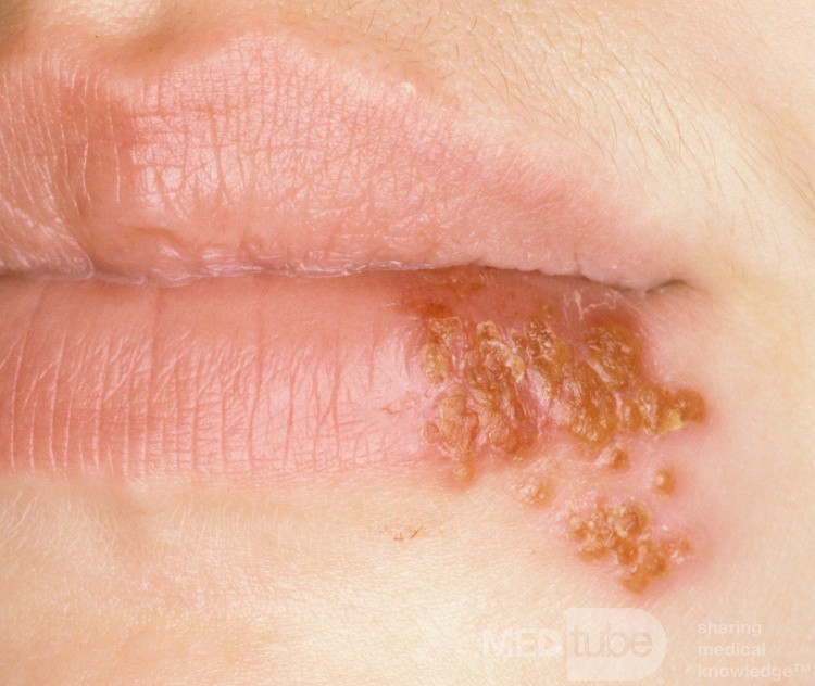 Herpes labialis an der Unterlippe