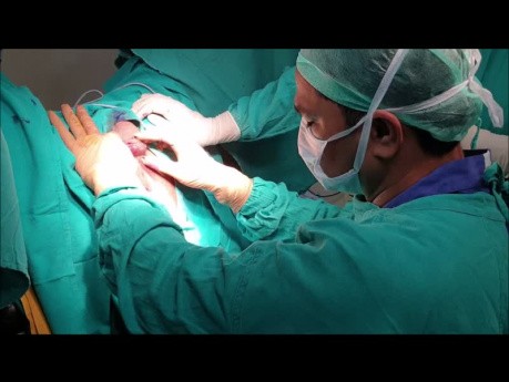 Ausbreitung der Analfistel in Testis