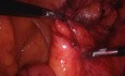 Laparoscopic Reversal of Hartmann's Colostomy