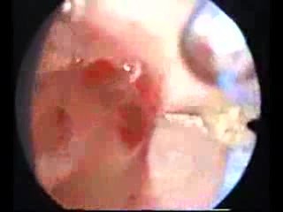 Uterus septus- Hysteroskopie