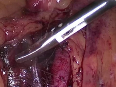 Laparoskopie als die beste Diagnosemethode bei akuten chirurgischen Fälle und bei der Diagnose von Patienten mit Metastase in dem Peritonealraum