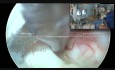 Interlaminäre endoskopische Dekompression bei lumbaler Diskushernie und S1 Osteophyten