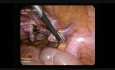 Totale laparoskopische Hysterektomie