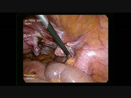 Totale laparoskopische Hysterektomie