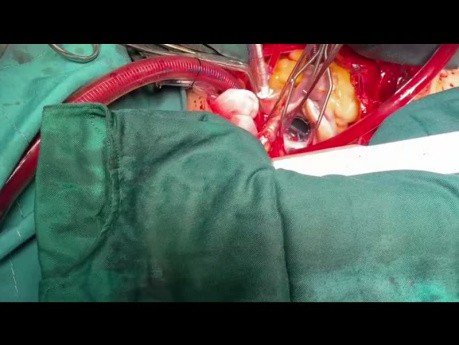 Modifizierte Mitralklappenreparatur bei Patient mit kleinem linken Vorhof