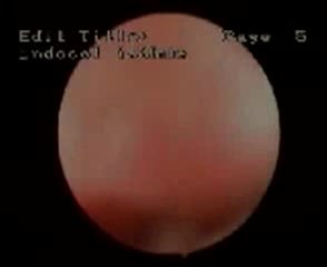 Diagnostische Hysteroskopie- Atrophie des Endometriums