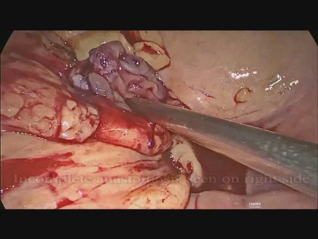 Eine Revision der Anastomose nach einer laparoskopischen anterioren Resektion