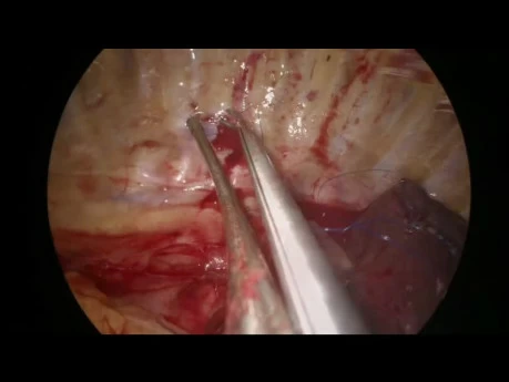 Uniportale VATS-Manschetten-Reimplantation des Mittellappens an den Bronchus intermedius