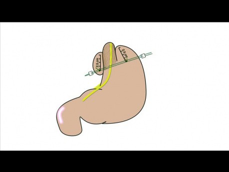 Geometry Fundoplication App Tutorial: Teil 8. Animation der Technik der Fundoplikatio 