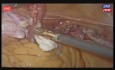 Totale laparoskopische Hysterektomie (3D)