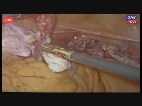 Totale laparoskopische Hysterektomie (3D)