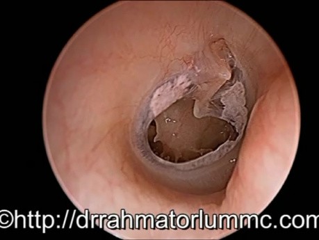 Zentrale Perforation des rechten Trommelfells mit Myringosklerose-Plaques anterosuperior und posterosuperior
