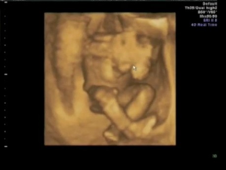 Das Ultraschallbild einer Schwangerschaft