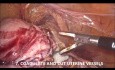 Goels Technik der laparoskopischen Hysterektomie (1 Stunde unbearbeitetes Video, 10 Schritte für eine sichere Operation)