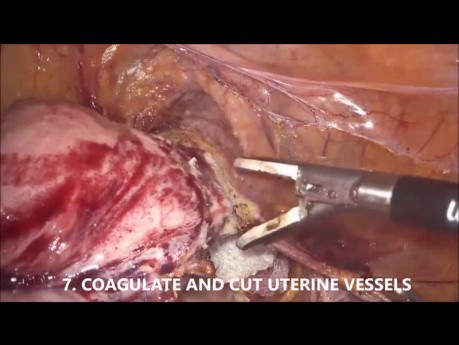 Goels Technik der laparoskopischen Hysterektomie (1 Stunde unbearbeitetes Video, 10 Schritte für eine sichere Operation)