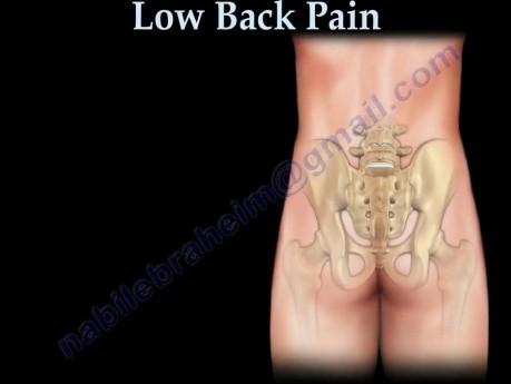 Sakroiliakalgelenk - Ursache für Rückenschmerzen im unteren Rücken - Video-Vorlesung