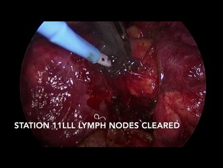 VATS-Lobektomie linker Unterlappen bei nicht-kleinzelligem Bronchialkarzinom