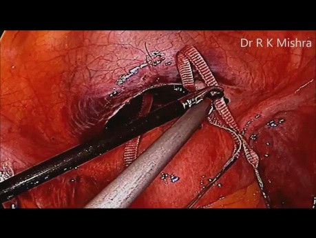 Die laparoskopische Cerclage bei Zervixinsuffizienz