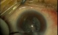 Phakoemulsifikation - Kataraktoperation