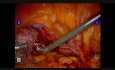 Robotische Sakrokolpopexie - Patientin nach Hysterektomie