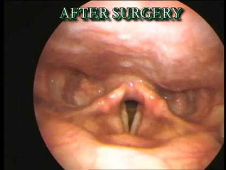 Endoskopische Ansicht vor und nach der Operation - Stimmlippenpolyp Teil II