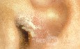 Psoriasis