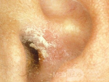 Psoriasis