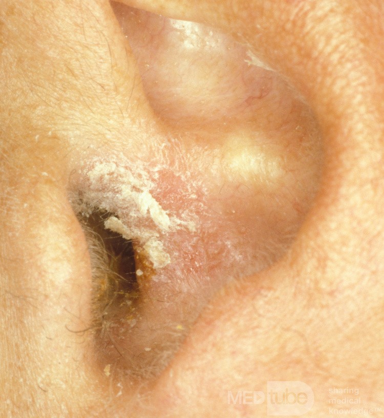 Psoriasis