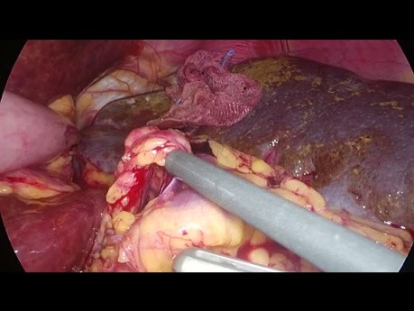 Laparoskopische Splenektomie bei der Agenesie des dorsalen Pankreas in "Vessel First"-Technik