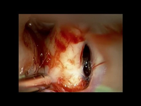 ACA-Aneurysma