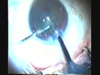 Phakoemulsifikation