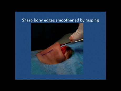 Rhinoplastik-Klassen Session 14, Spreader Flaps in Reduktion