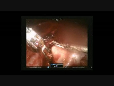 Robot Hysterektomie mit Cholezystektomie 