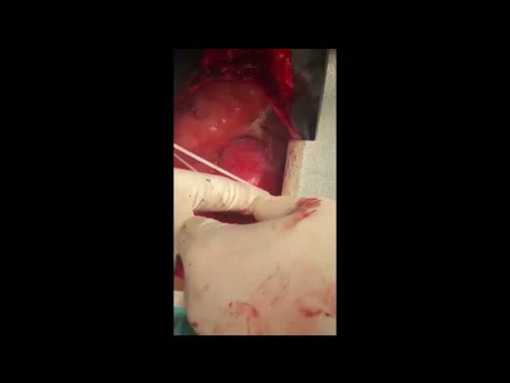 Florida-Technik für das Aneurysma der aufsteigenden Aorta und seine Modifikation
