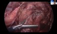 Gastrojejunostomie: Prinzipien, Techniken und Fallstricke
