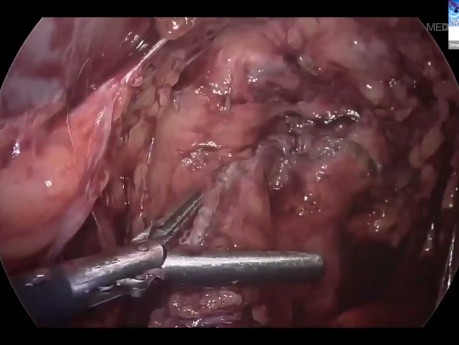 Gastrojejunostomie: Prinzipien, Techniken und Fallstricke