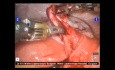 Roboterassistierte Chirurgie mit dem DaVinci-OP-System bei einer Ovarialzyste
