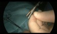 Laparoskopischer Verschluss der Inguinalhernie, perkutane Technik