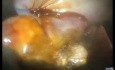 Evolution der laparo-endoskopischen Single-Site (LESS) Cholezystektomie ohne Allgemeinanästhesie