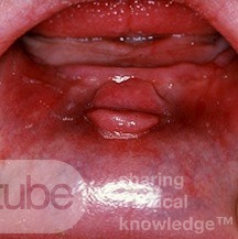 Granulom als Folge von Zahnersatz