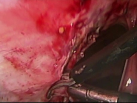 Endometriose im Thorax