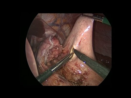Roux-en Y Magenbypass Umkehrung